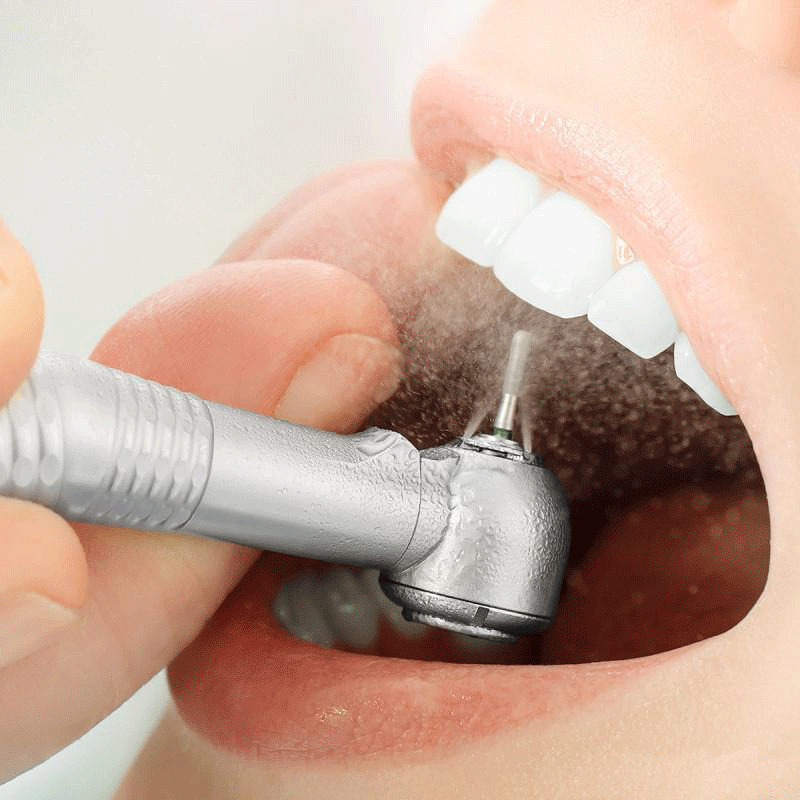 کاربرد سندبلاست در دندانپزشکی